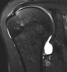 MRI Normal Humeral IGHL Insertion